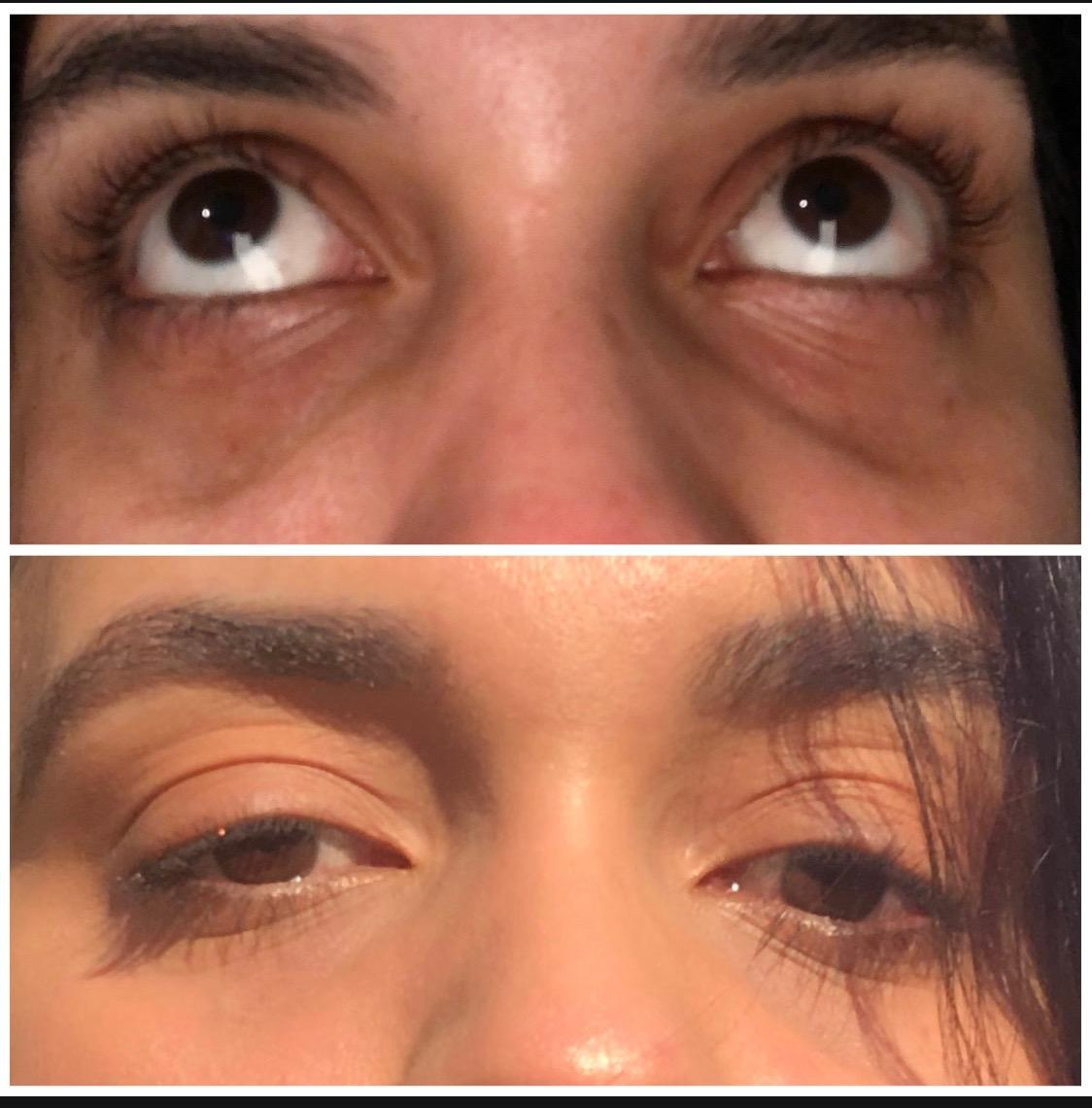 Before and after pic of reviewer with dark under eyes that are gone in the second pic 