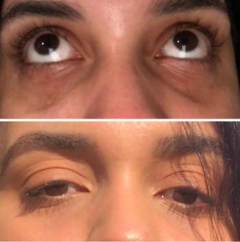 Before and after pic of reviewer with dark under eyes that are gone in the second pic 