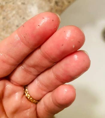 reviewer's hands showing dormant tegument that came disconnected aft cleansing