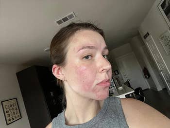 Person in a sleeveless top poses for a selfie, showing the side of their face with acne