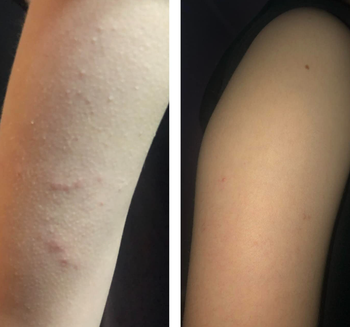reviewer before and after image of how keratosis pilaris diminished after using wash
