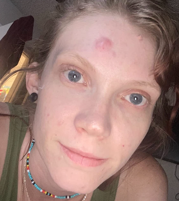 reviewer with large dot of acne on forehead 