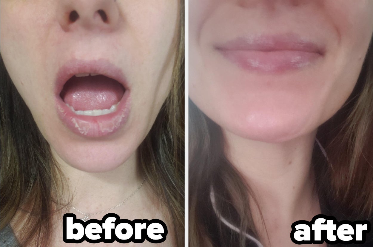 a split image of a reviewer's cracked lips before balm and after looking sooth and moisturized 
