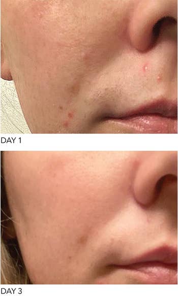a before and after of someone who used the gel and had their acne reduced