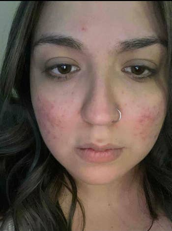 image of a reviewer with acne and red skin