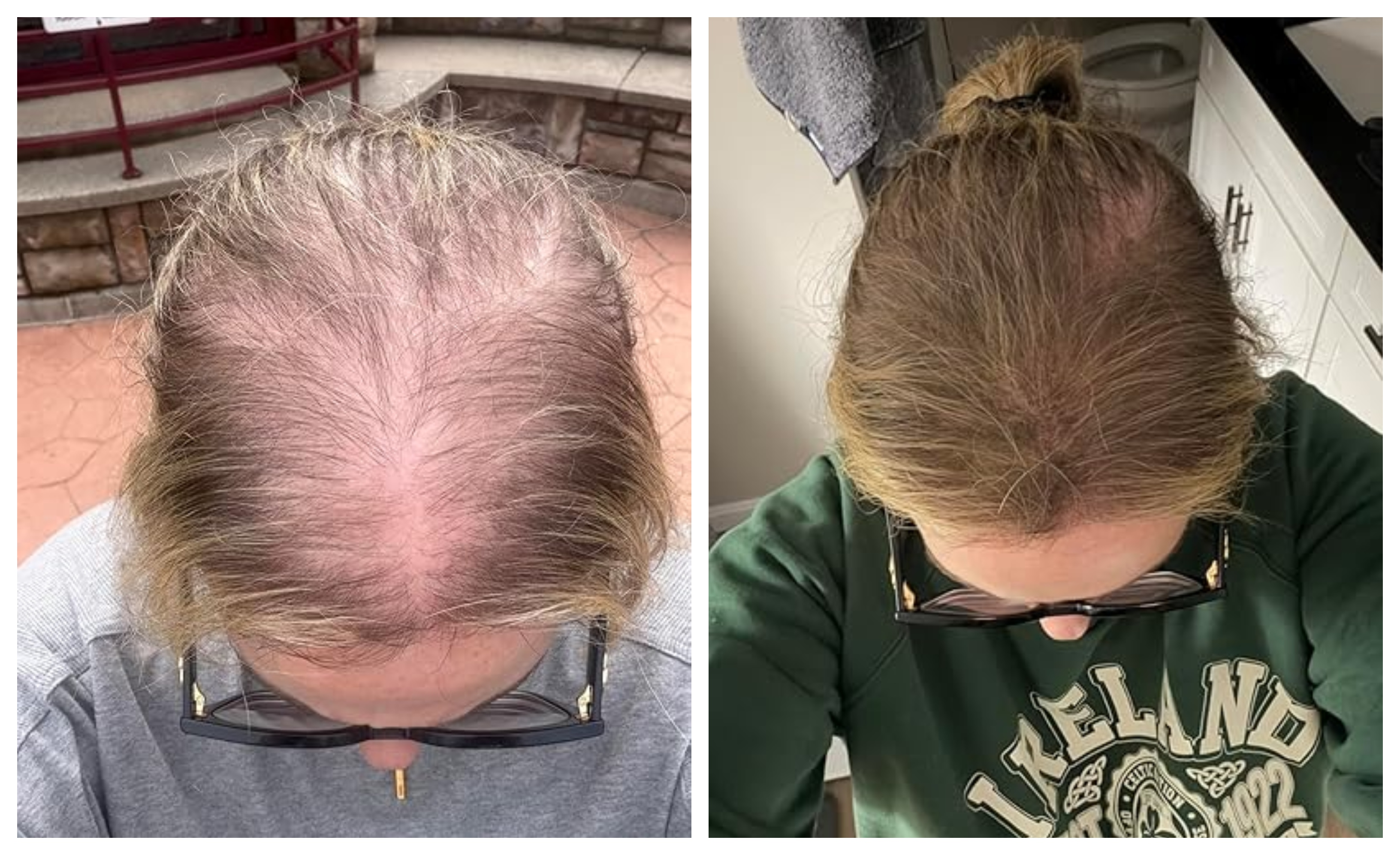 Before and aft  photos showing hairsbreadth  thinning betterment  connected  a person's scalp