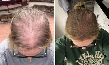Before and aft photos showing hairsbreadth thinning betterment connected a person's scalp