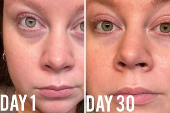 Before and after close-up of a reviewers' face, showing dark circles lessening under their eyes over 30 days 