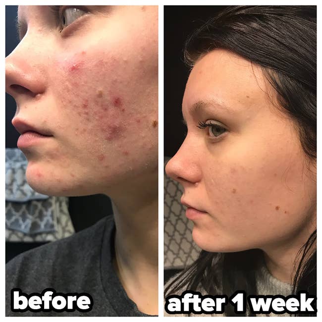reviewer inflamed, red skin before using cleanser and 1 week after looking moisturized and smooth
