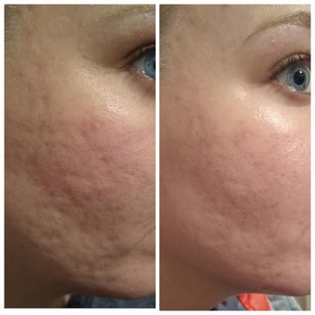 Reviewer showing results of using Roc retinol cream