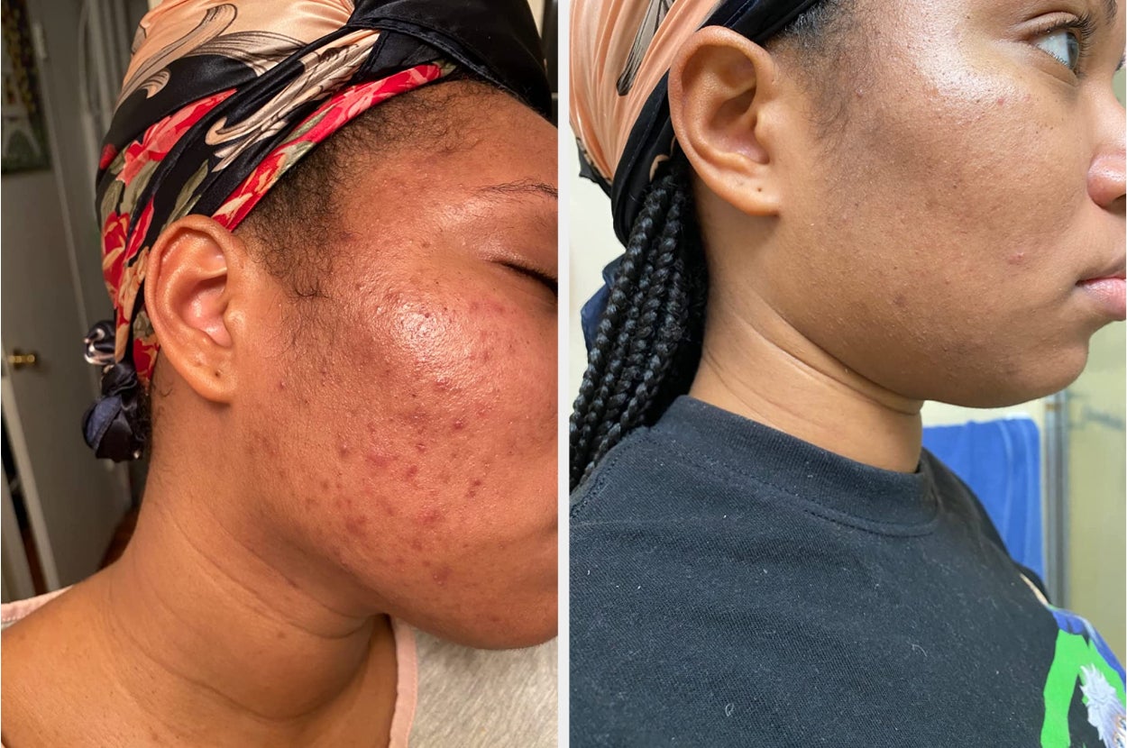 side-by-side of a reviewer's irritated skin before using the liquid exfoliant and then their clearer and brighter skin after using the liquid exfoliant 