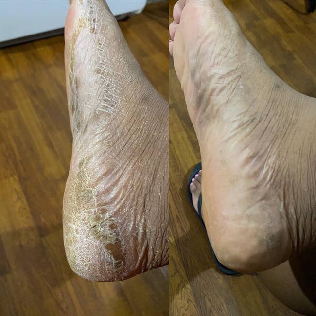 Before representation of a cracked and adust heel; After representation of the aforesaid bottommost present smooth