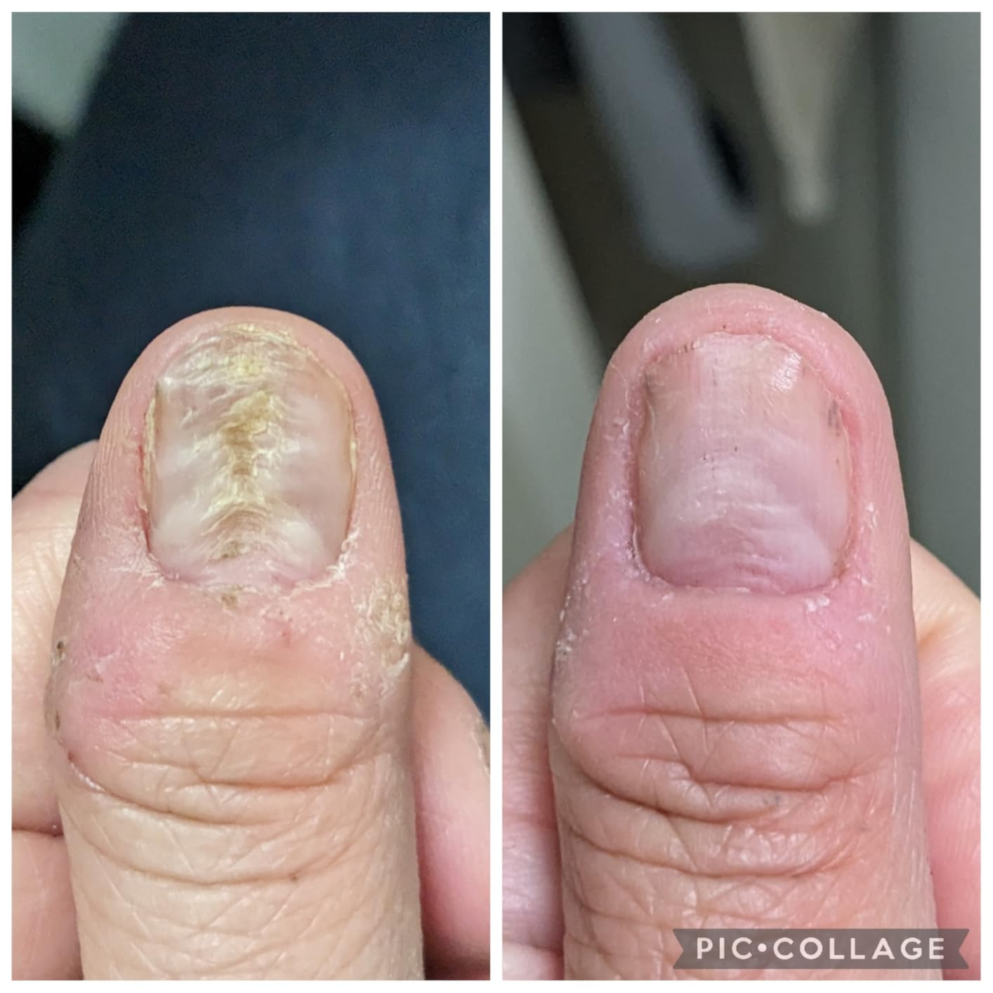 Close-up examination  of a damaged fingernail and its improved condition, showing tegument  and nail recovery