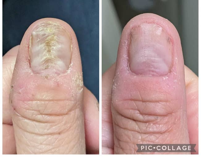 Close-up examination of a damaged fingernail and its improved condition, showing tegument and nail recovery