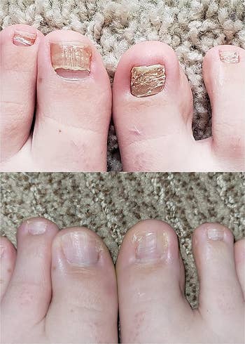 Before and after photos of toenails, the top with chipped polish, bottom showing healthy nails after using the anti-fungal polish
