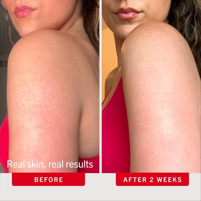 Before and after comparison of an arm treated for skin texture improvement over two weeks, showing smoother skin on the right