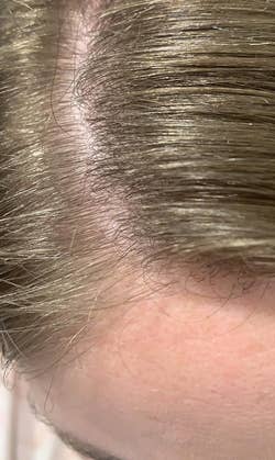 Close-up of a reviewer's dandruff-free hairline and scalp