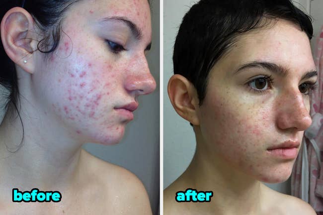 Before and after images of a person's reduced acne after using the snail mucin serum