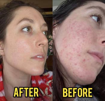 A reviewer with more acne scars in one photo and with much clearer-looking skin in the other photo