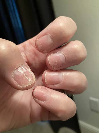 before image of reviewer's cracked and peeling nails