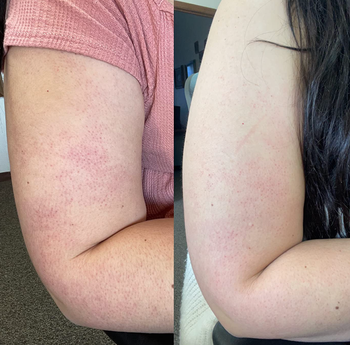reviewer before and after showing the product reduce the appearance of skin bumps
