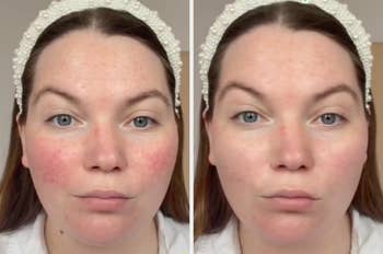 before and after image of model using the product to reduce redness 