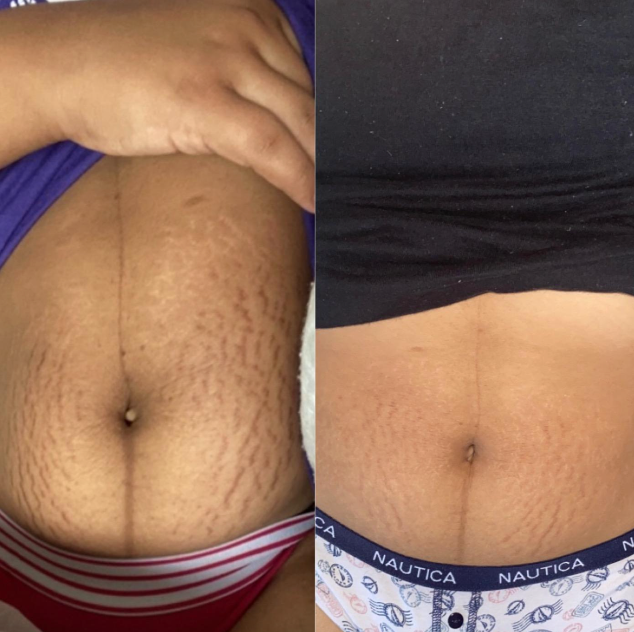 reviewer before and after photo showing how the bio oil helped to lighten their stretch marks