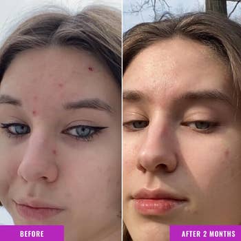  Before and aft  2  months of skincare attraction    showing simplification  successful  acne