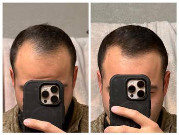 Before and aft photograph of a person's hairsbreadth restoration progress, showing accrued hairsbreadth thickness and density. Person is holding a smartphone successful front