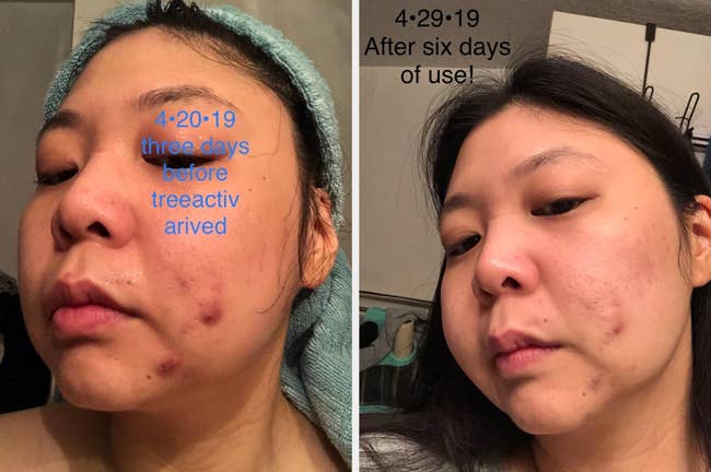 before/after of reviewer's face after using the cystic acne treatment for six days, showing much clearer skin with reduced breakouts