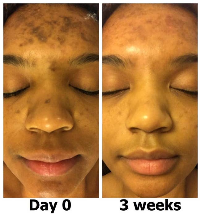 on left, dark spots on forehead. on right, same forehead with less dark spots