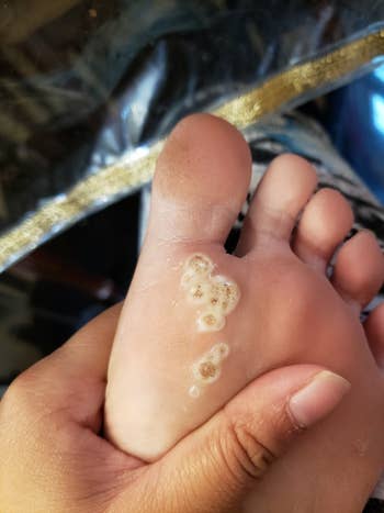 reviewer foot with warts