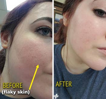 a reviewer shows an before and after of flaky skin now gone