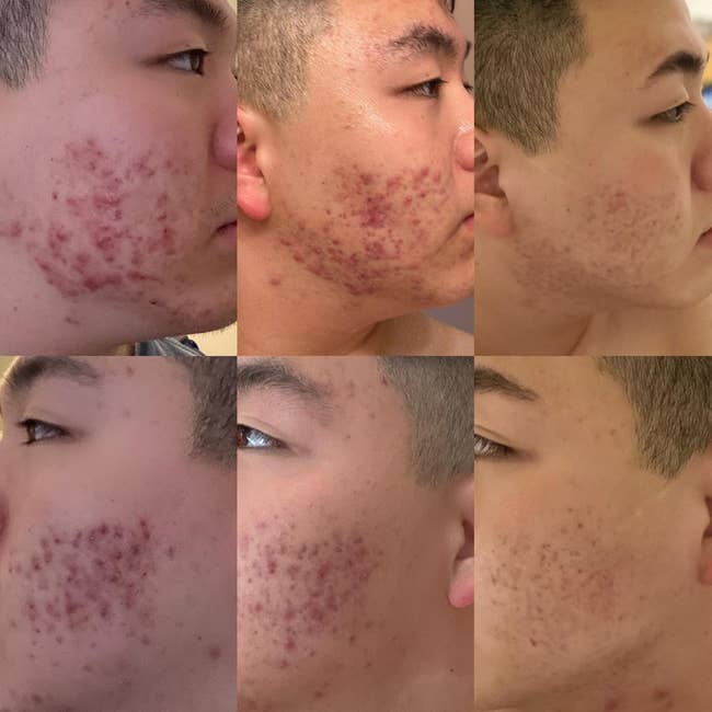 reviewer's skin before and after using gel with noticeable differences and red spots faded