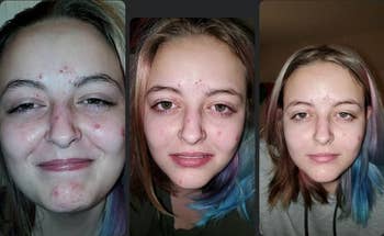 Reviewers three facial progress photos of their reducing acne