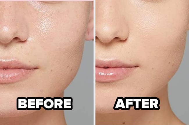 Close-up of a person's face showing a skincare treatment result; 