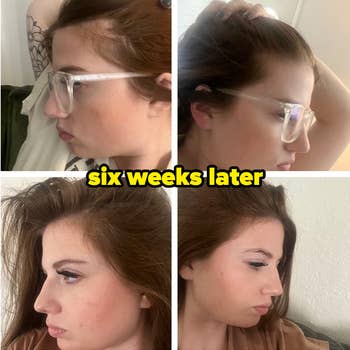 Reviewer showing before and after hair growth at the top of their scalp six weeks after use