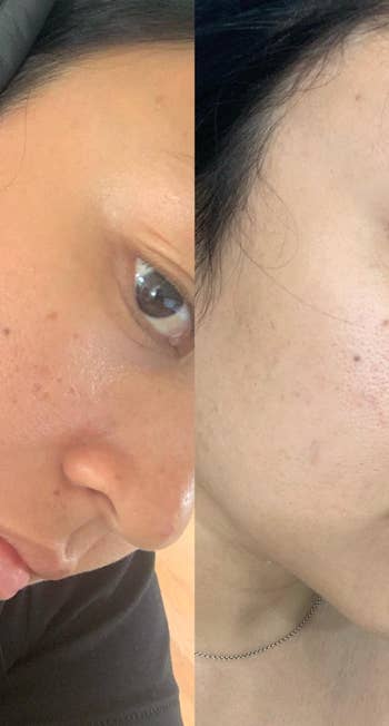 a reviewer's skin with acne scars and visible spotting 