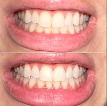 reviewer smiling before and after with less yellow between their teeth 