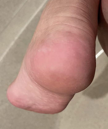 reviewer after photo showing their heel is callus-free