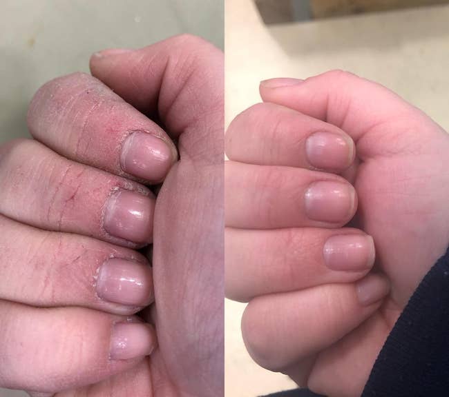 A divided representation showing a earlier and aft of hands, with visibly improved tegument texture and quality successful the aft photo