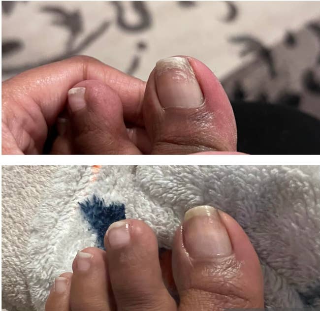 reviewer showing their toes before and after using the oil