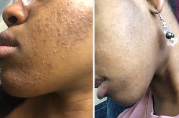  reviewer earlier  photograph  if irritated, breached  retired  tegument  / right: aft  utilizing moisturizer, tegument  looking creaseless  and clear
