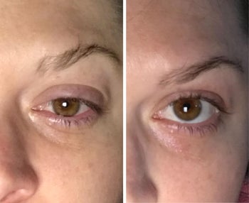 reviewer before and after using the ice roller around their eyes