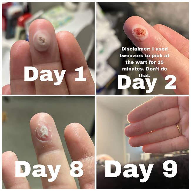 four panels showing a wart in various stages of removal over the course of nine days 