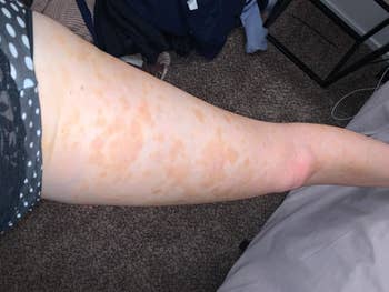 reviewer photo showing their eczema on their leg