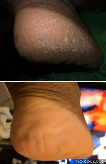 another reviewers foot before and after using callus remover, feet appear smoother after