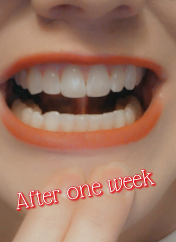 same reviewer's teeth a week after use with noticeably brighter smile 