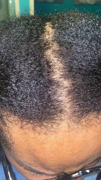 reviewers scalp after using shampoo, dandruff gone
