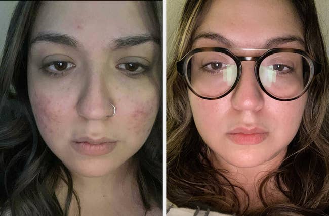Before and after showing the scrub evened reviewer's skin tone and helped get rid of breakouts on their cheek 
